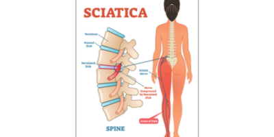 sciatica treatments